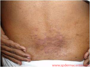 Psoriasis-After
